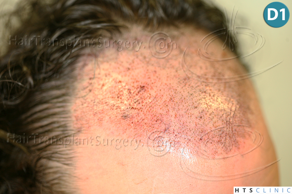 Dr.Devroye-HTS-Clinic-3290-FUT-NWIIIA-9.jpg