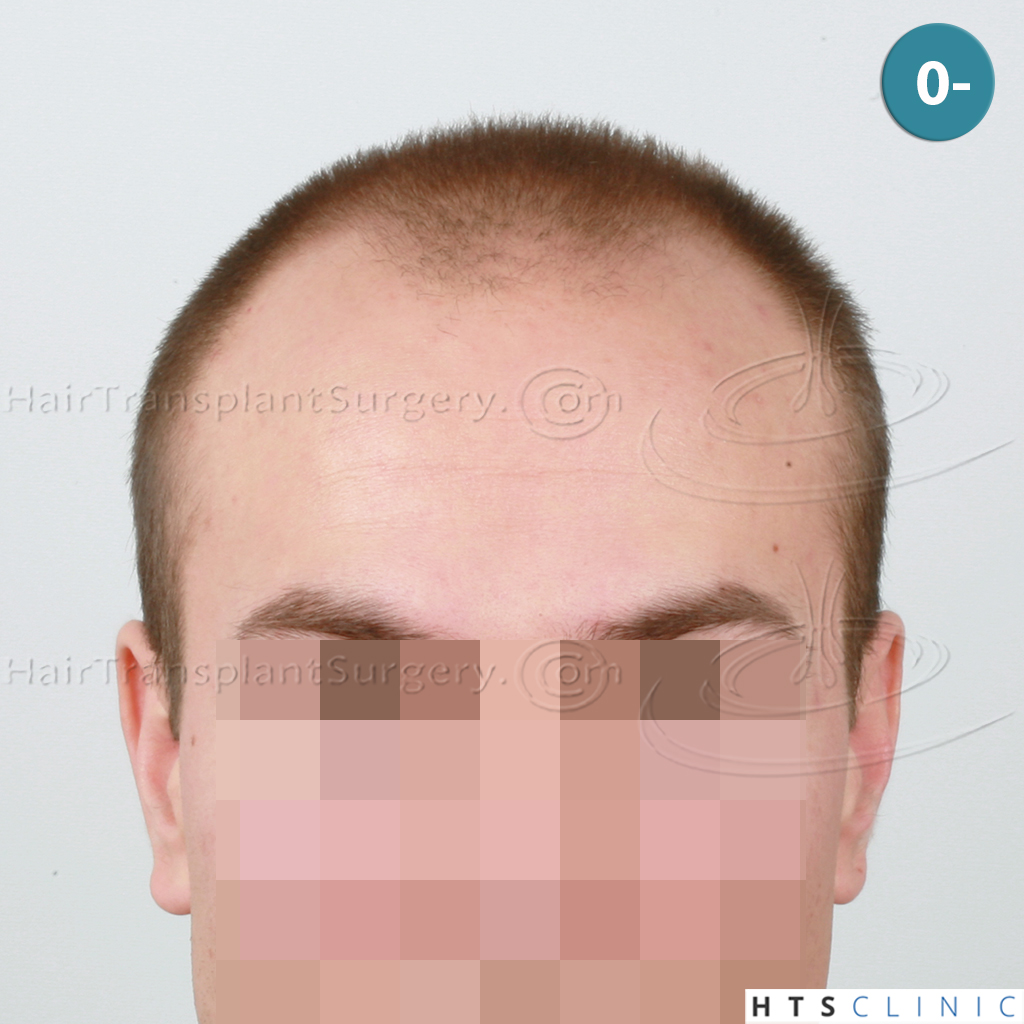 Dr.Devroye-HTS-Clinic-4205-FUE-NW-V-1.jpg
