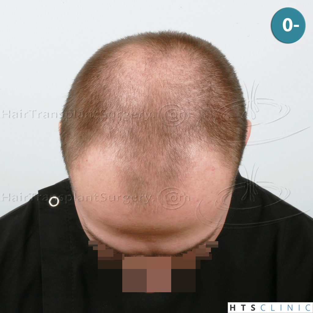 Dr.Devroye-HTS-Clinic-4205-FUE-NW-V-2.jpg