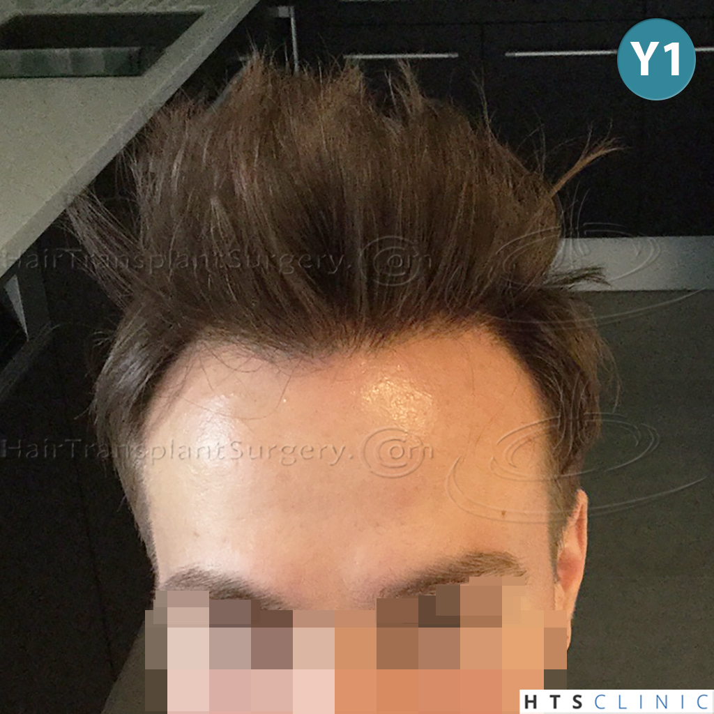 Dr.Devroye-HTS-Clinic-4205-FUE-NW-V-24.jpg