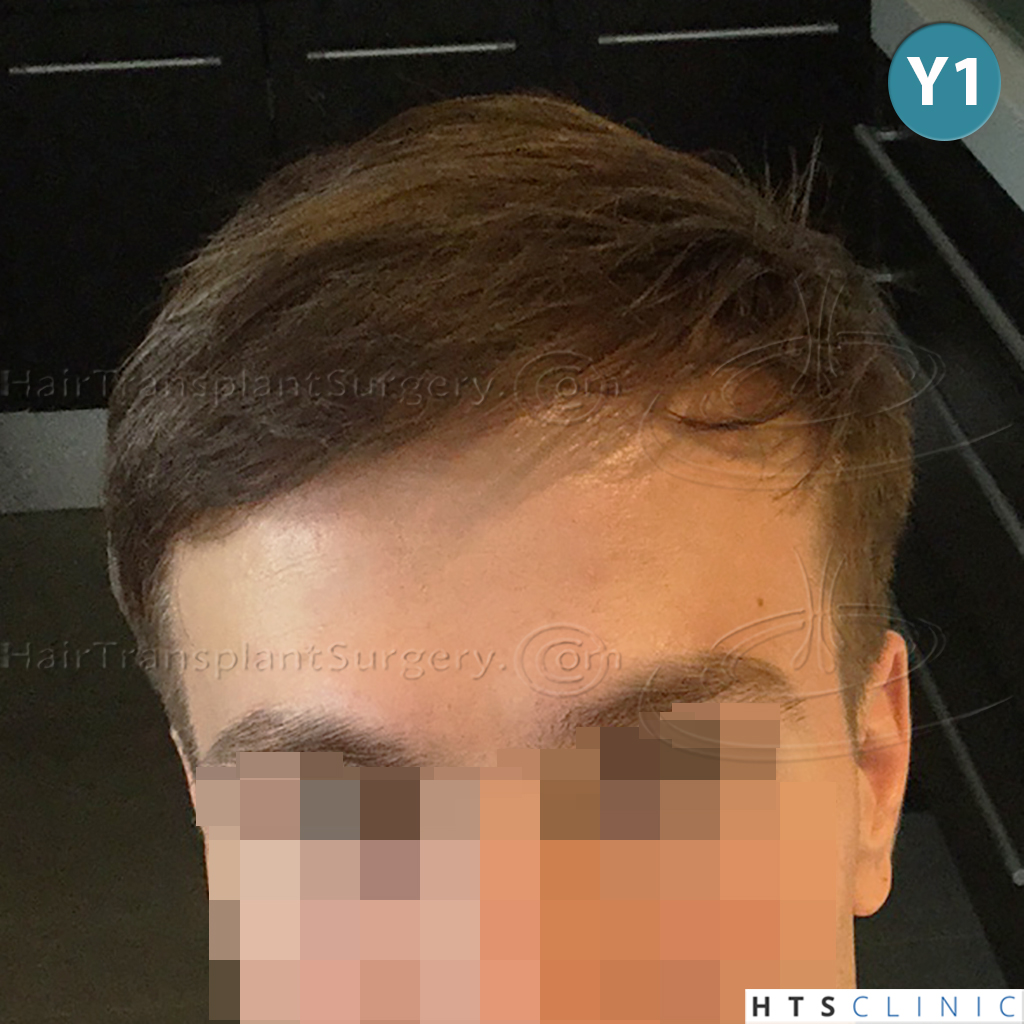 Dr.Devroye-HTS-Clinic-4205-FUE-NW-V-23.jpg