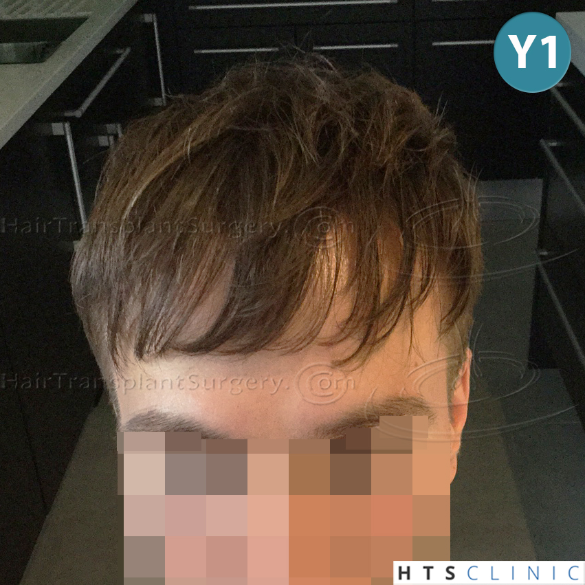 Dr.Devroye-HTS-Clinic-4205-FUE-NW-V-25.jpg