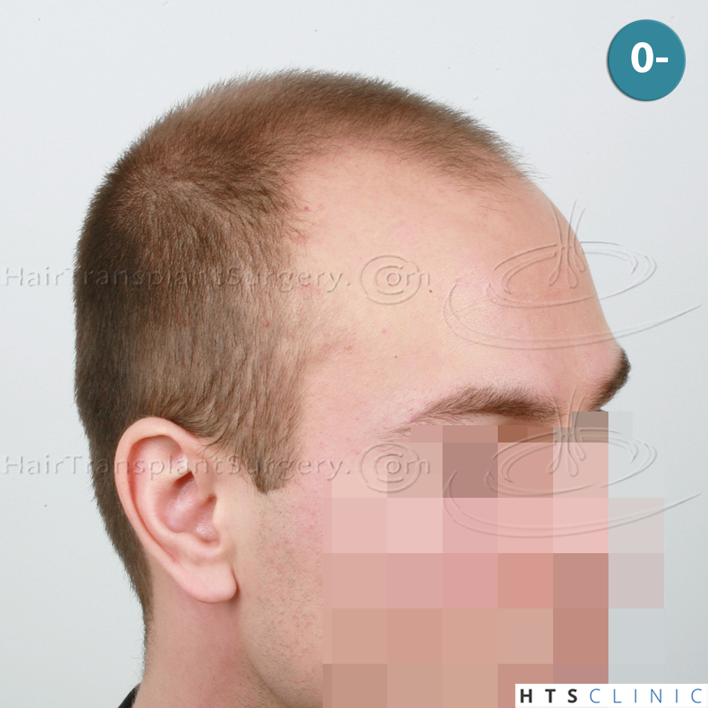 Dr.Devroye-HTS-Clinic-4205-FUE-NW-V-4.jpg
