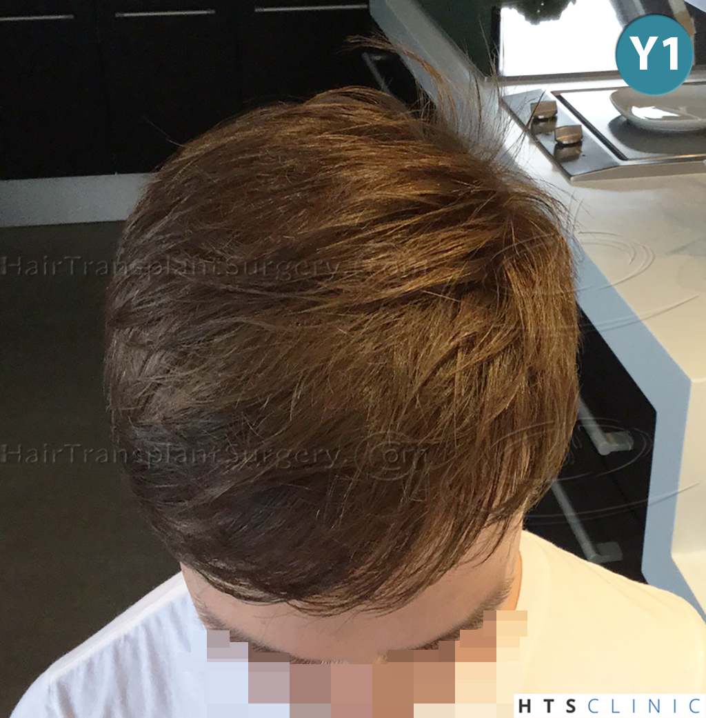 Dr.Devroye-HTS-Clinic-4205-FUE-NW-V-26.jpg