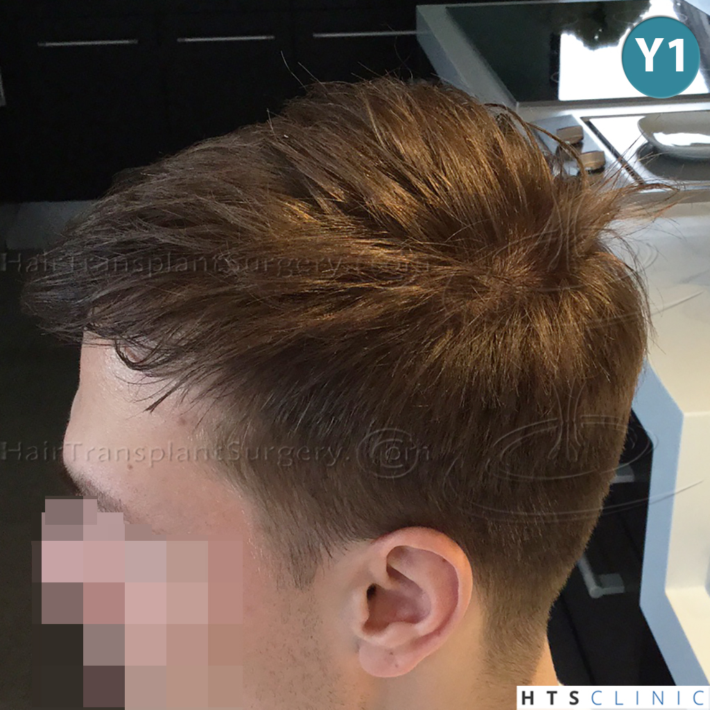 Dr.Devroye-HTS-Clinic-4205-FUE-NW-V-27.jpg