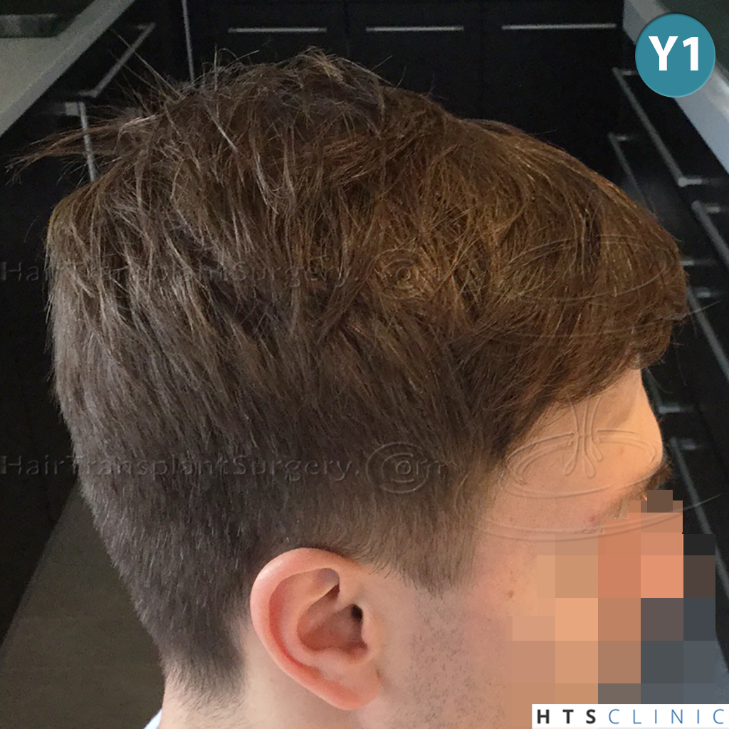 Dr.Devroye-HTS-Clinic-4205-FUE-NW-V-28.jpg