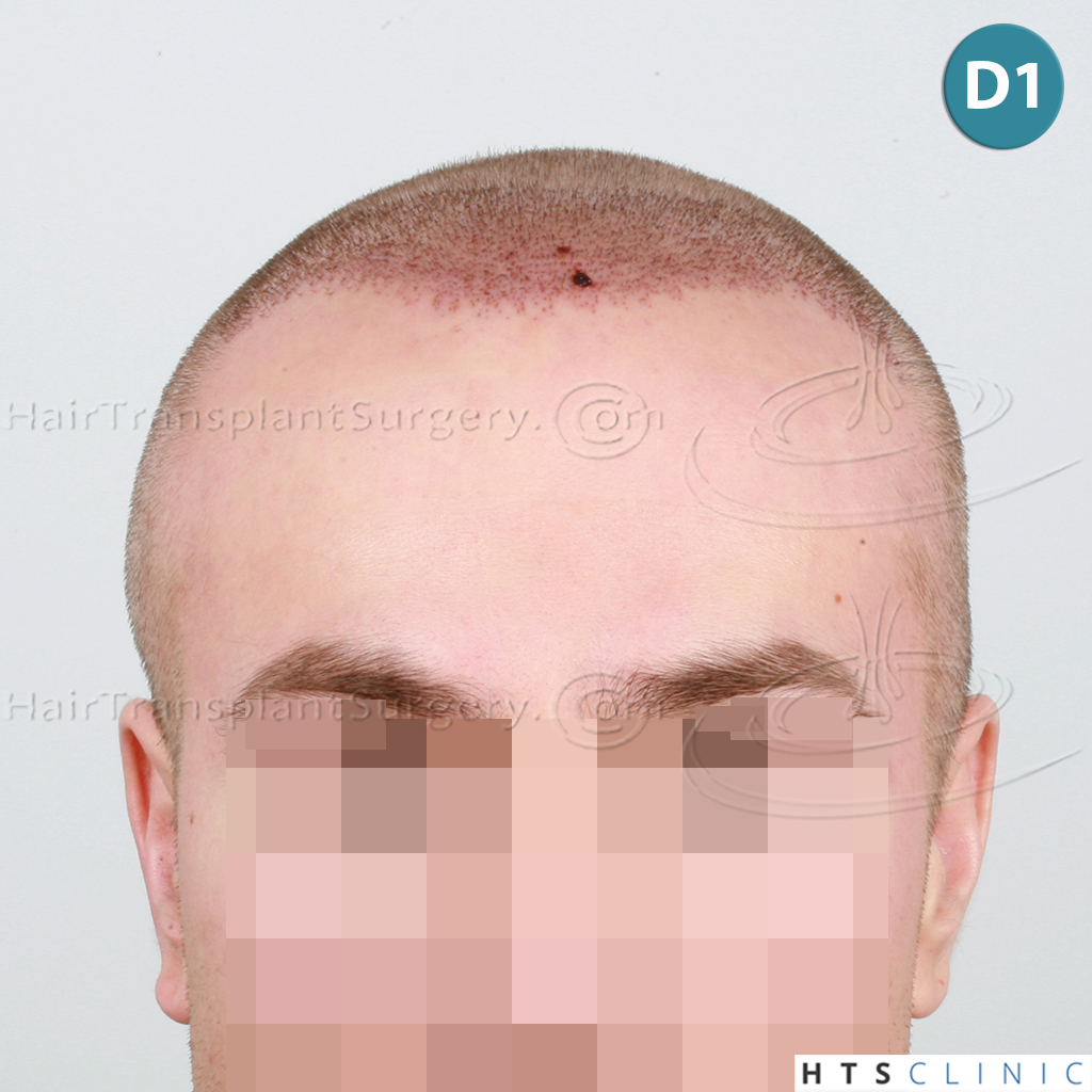 Dr.Devroye-HTS-Clinic-4205-FUE-NW-V-7.jpg