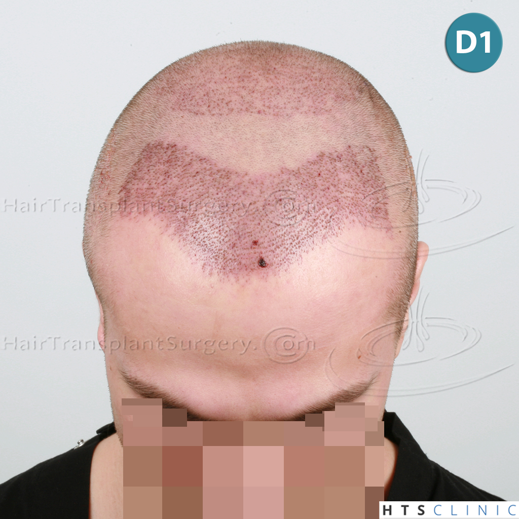 Dr.Devroye-HTS-Clinic-4205-FUE-NW-V-8.jpg