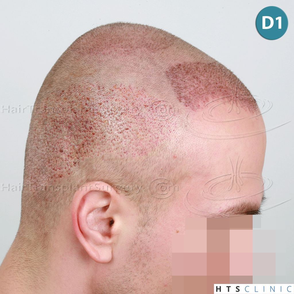 Dr.Devroye-HTS-Clinic-4205-FUE-NW-V-11.jpg