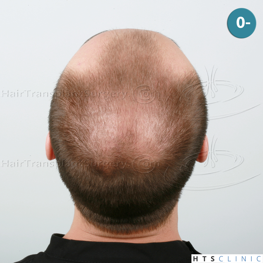 Dr.Devroye-HTS-Clinic-4205-FUE-NW-V-6.jpg