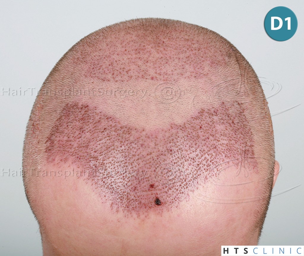 Dr.Devroye-HTS-Clinic-4205-FUE-NW-V-9.jpg