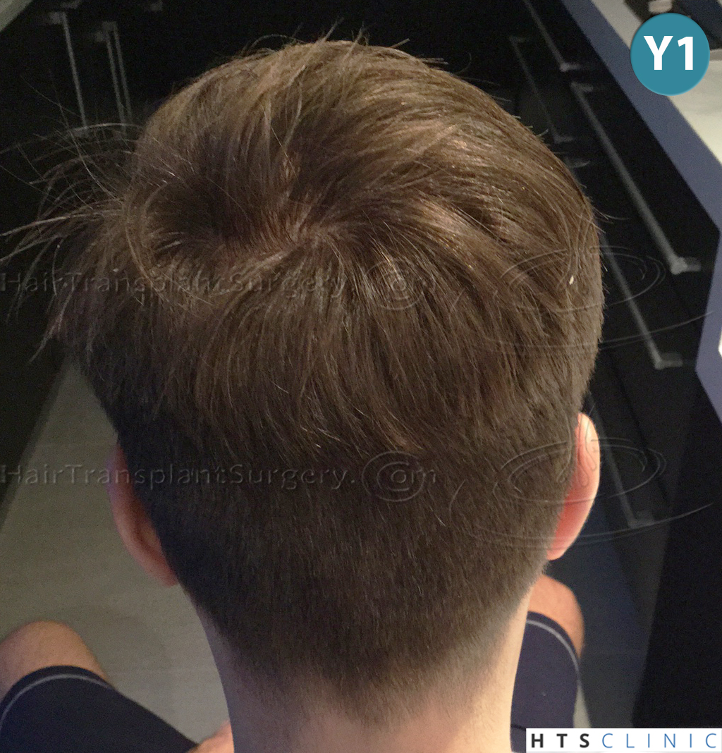 Dr.Devroye-HTS-Clinic-4205-FUE-NW-V-29.jpg
