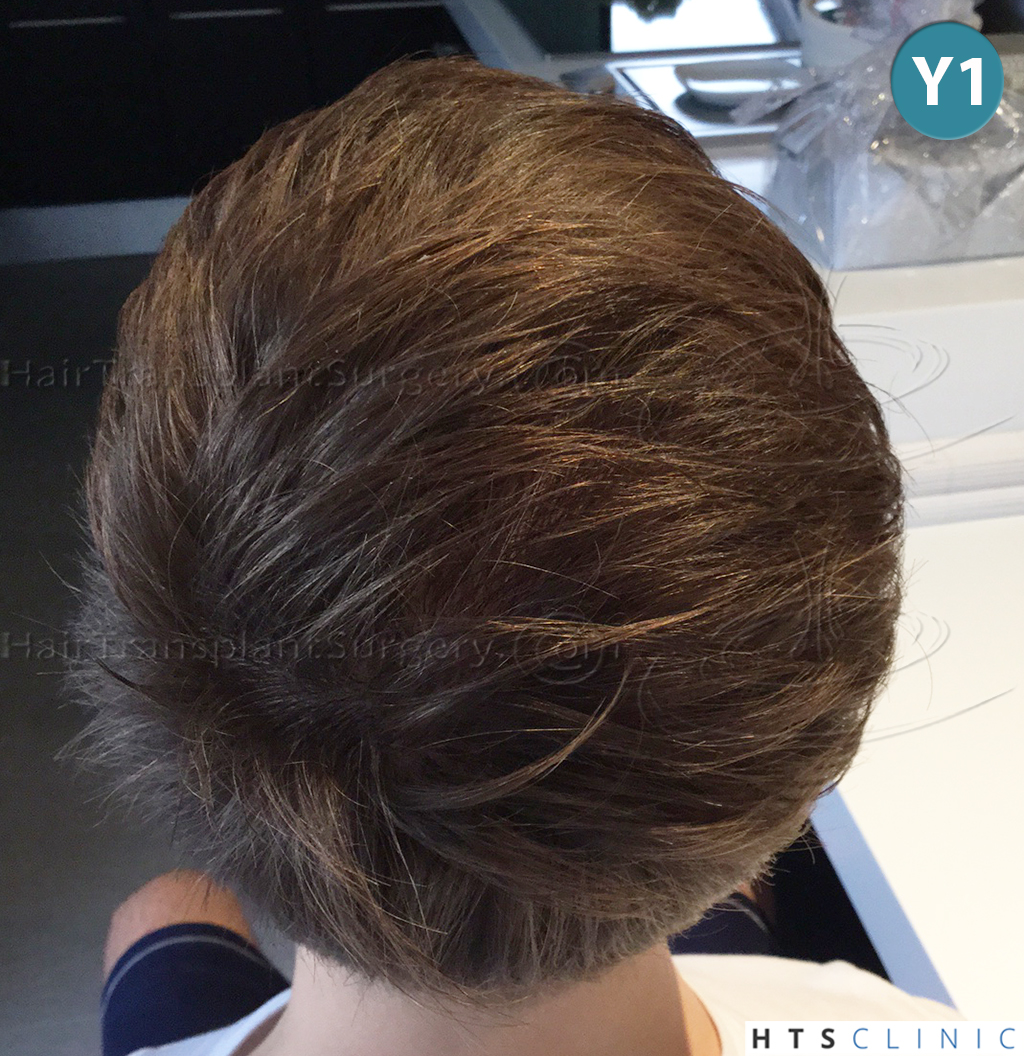 Dr.Devroye-HTS-Clinic-4205-FUE-NW-V-30.jpg