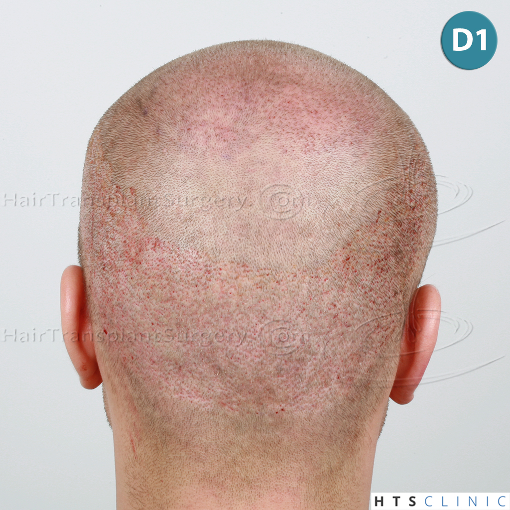 Dr.Devroye-HTS-Clinic-4205-FUE-NW-V-12.jpg
