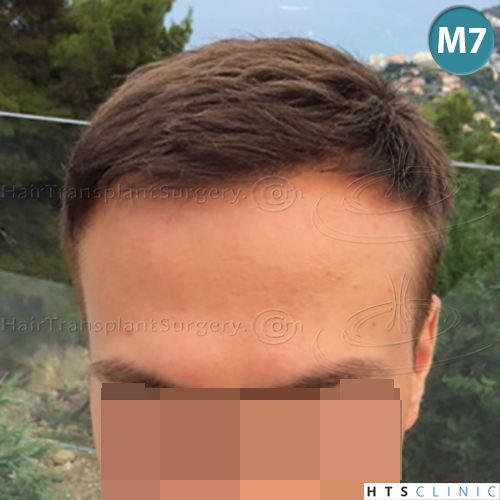 Dr.Devroye-HTS-Clinic-4205-FUE-NW-V-14.jpg
