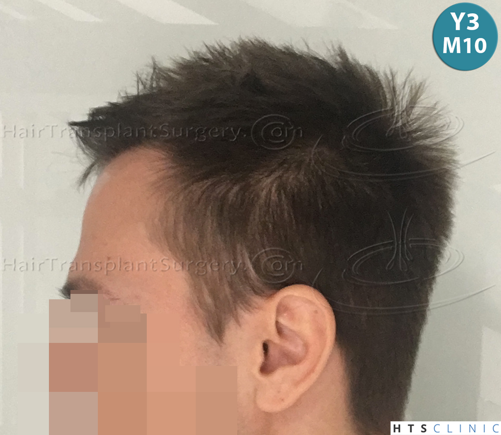 Dr.Devroye-HTS-Clinic-4205-FUE-NW-V-34.jpg