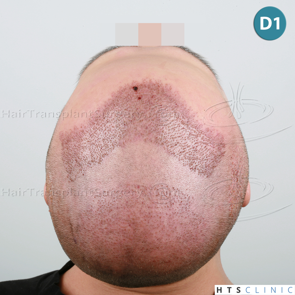 Dr.Devroye-HTS-Clinic-4205-FUE-NW-V-13.jpg