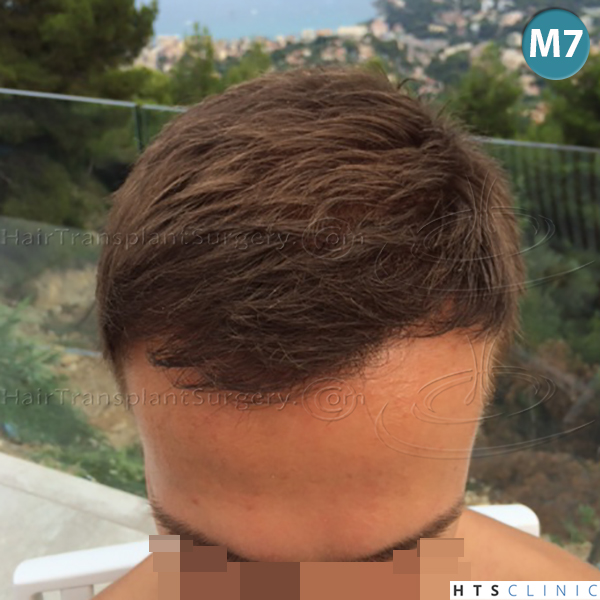 Dr.Devroye-HTS-Clinic-4205-FUE-NW-V-15.jpg
