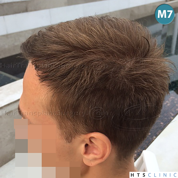 Dr.Devroye-HTS-Clinic-4205-FUE-NW-V-16.jpg