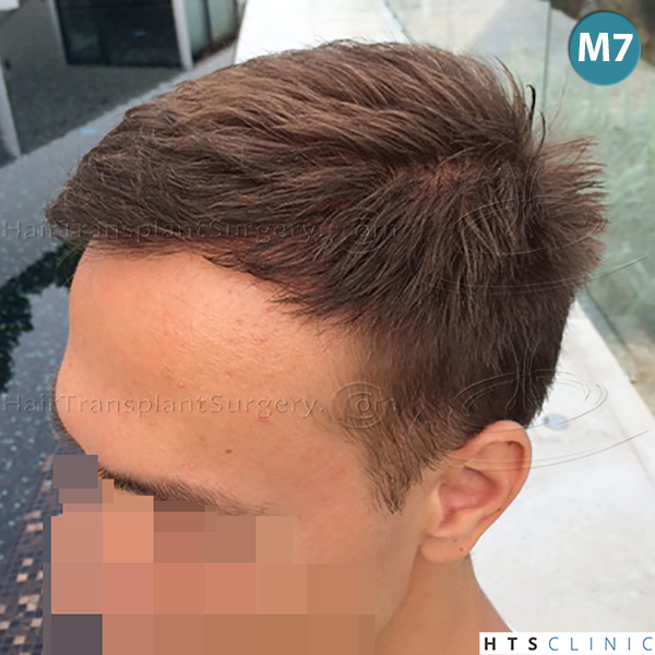 Dr.Devroye-HTS-Clinic-4205-FUE-NW-V-17.jpg