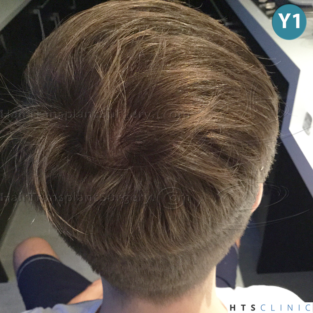 Dr.Devroye-HTS-Clinic-4205-FUE-NW-V-31.jpg