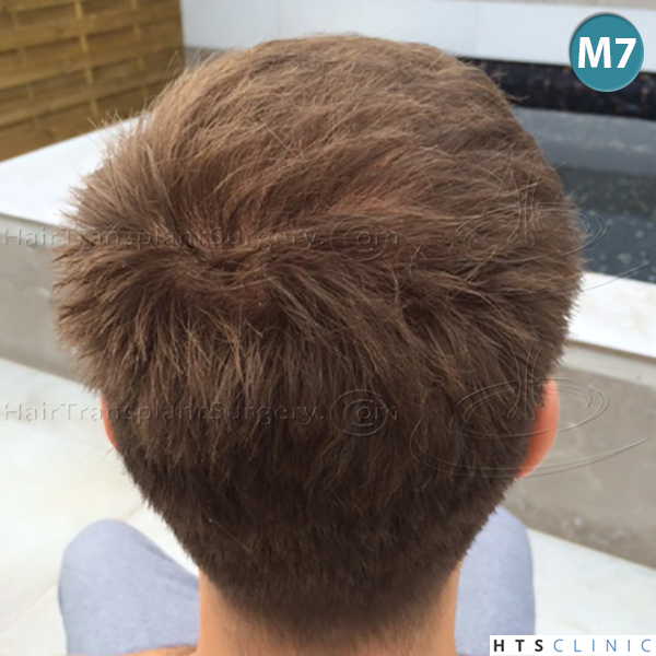 Dr.Devroye-HTS-Clinic-4205-FUE-NW-V-20.jpg