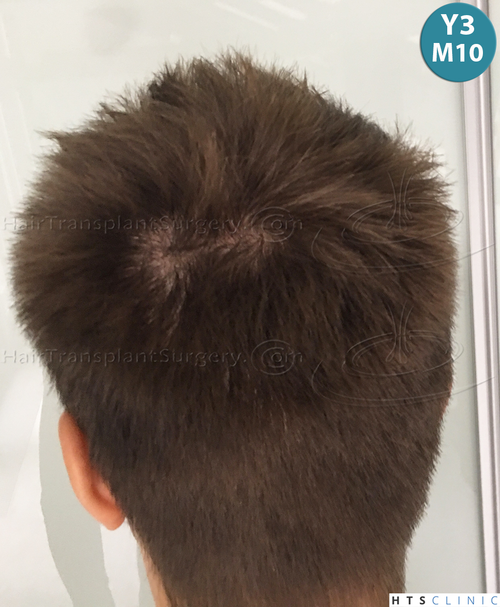 Dr.Devroye-HTS-Clinic-4205-FUE-NW-V-36.jpg