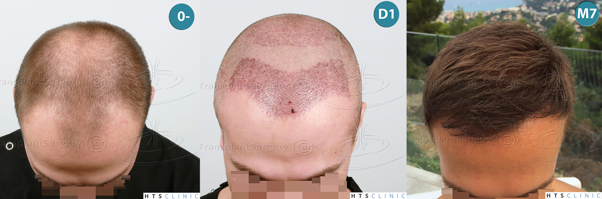 Dr.Devroye-HTS-Clinic-4205-FUE-NW-V-Montage1.jpg