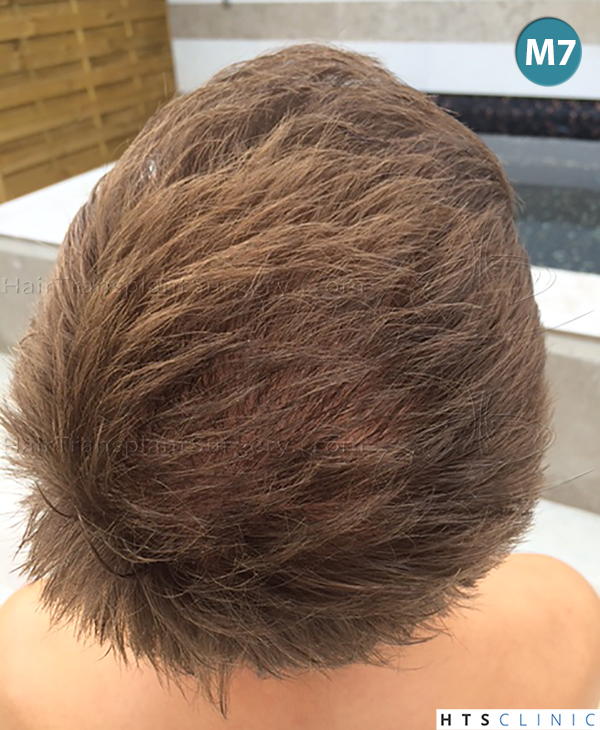 Dr.Devroye-HTS-Clinic-4205-FUE-NW-V-21.jpg