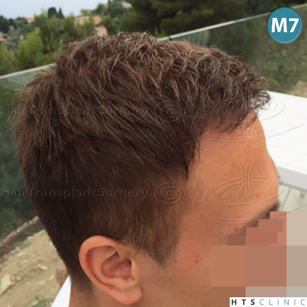 Dr.Devroye-HTS-Clinic-4205-FUE-NW-V-19.jpg