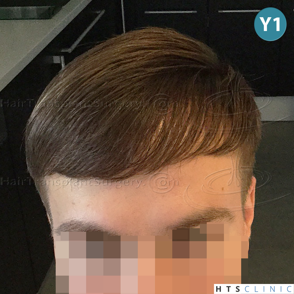 Dr.Devroye-HTS-Clinic-4205-FUE-NW-V-22.jpg