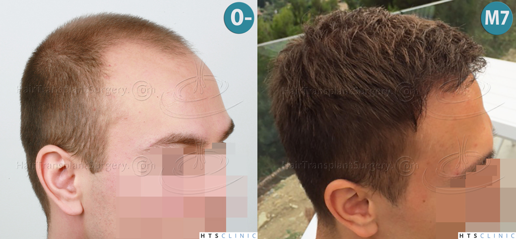 Dr.Devroye-HTS-Clinic-4205-FUE-NW-V-Montage2.jpg