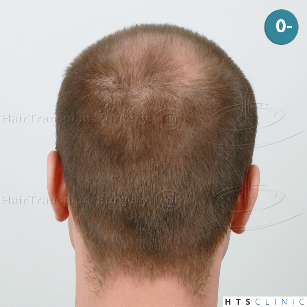 Dr.Devroye-HTS-Clinic-4205-FUE-NW-V-5.jpg