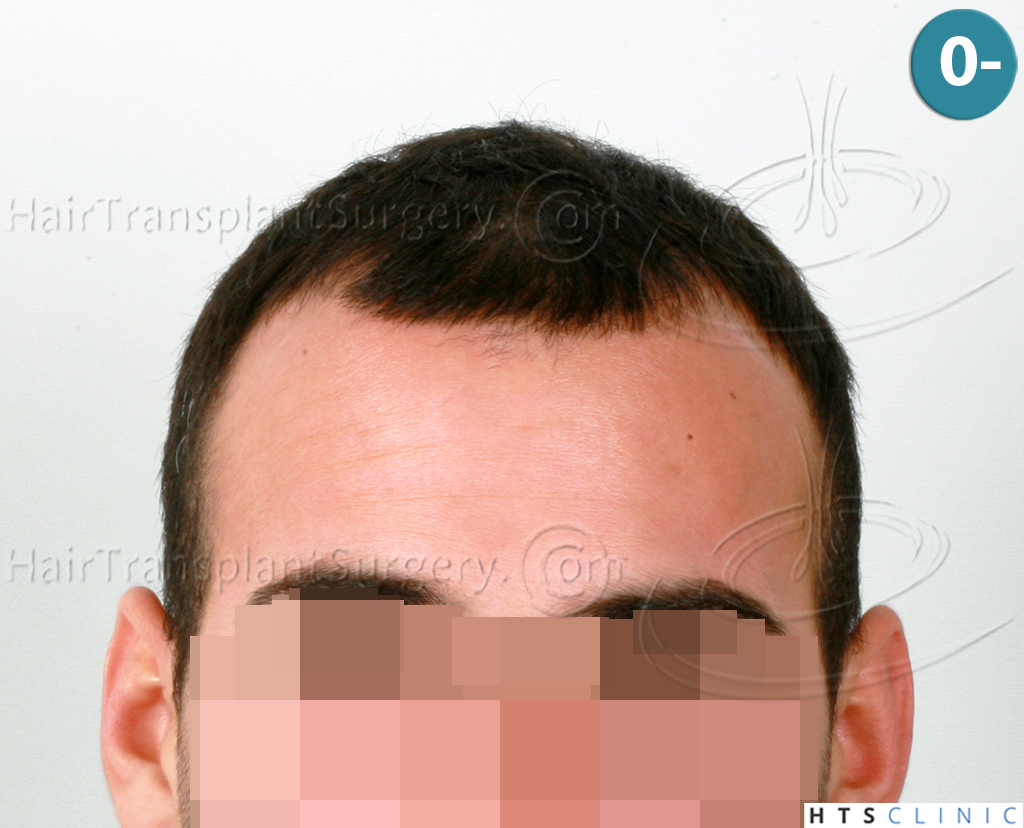 Dr.Devroye-HTS-Clinic-1880-FUE-NW-III-1.jpg