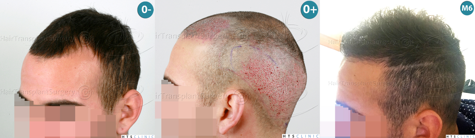 Dr.Devroye-HTS-Clinic-1880-FUE-NW-III-Montage2.jpg