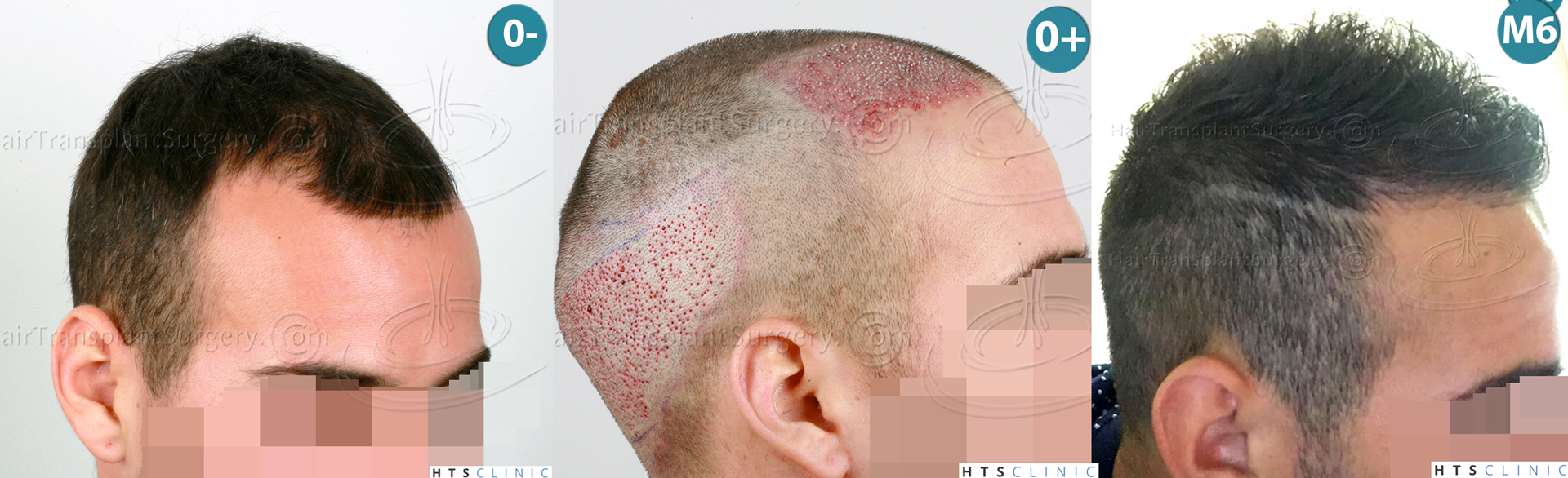 Dr.Devroye-HTS-Clinic-1880-FUE-NW-III-Montage3.jpg