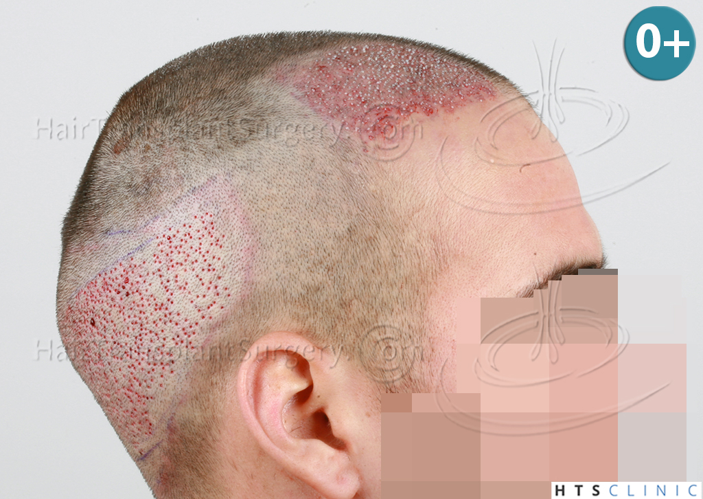 Dr.Devroye-HTS-Clinic-1880-FUE-NW-III-8.jpg