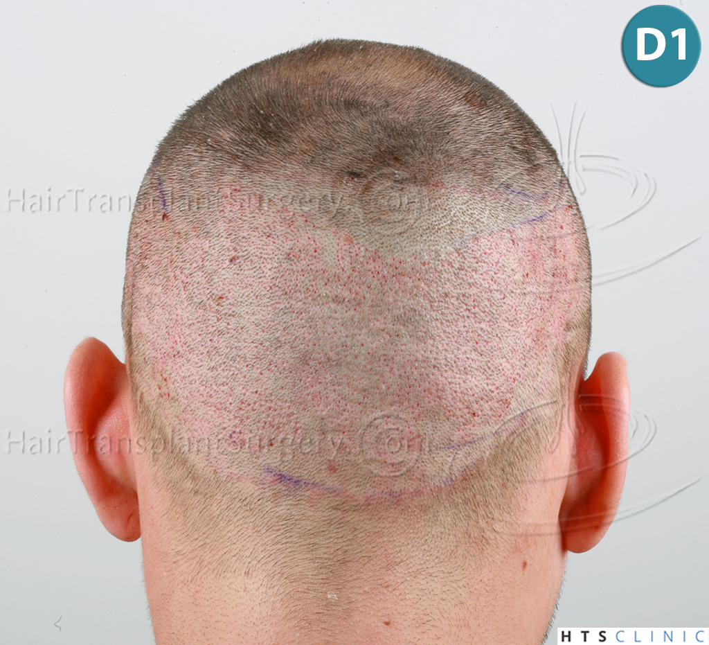 Dr.Devroye-HTS-Clinic-1880-FUE-NW-III-10.jpg