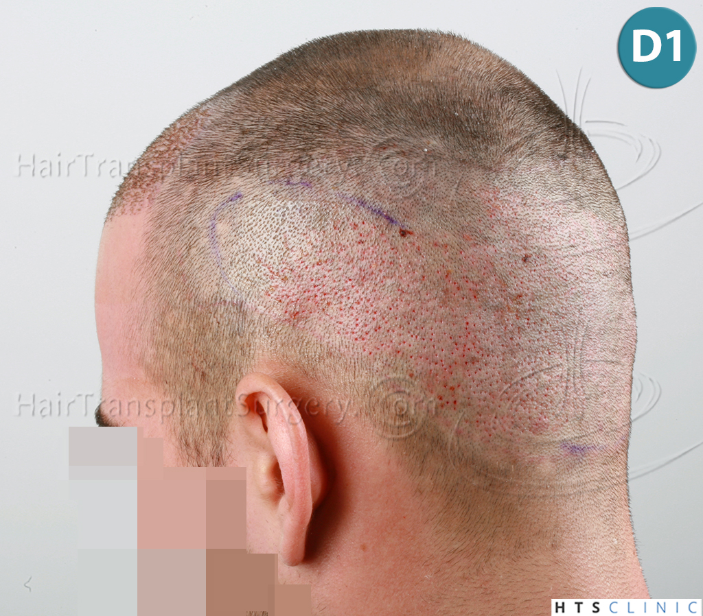 Dr.Devroye-HTS-Clinic-1880-FUE-NW-III-11.jpg
