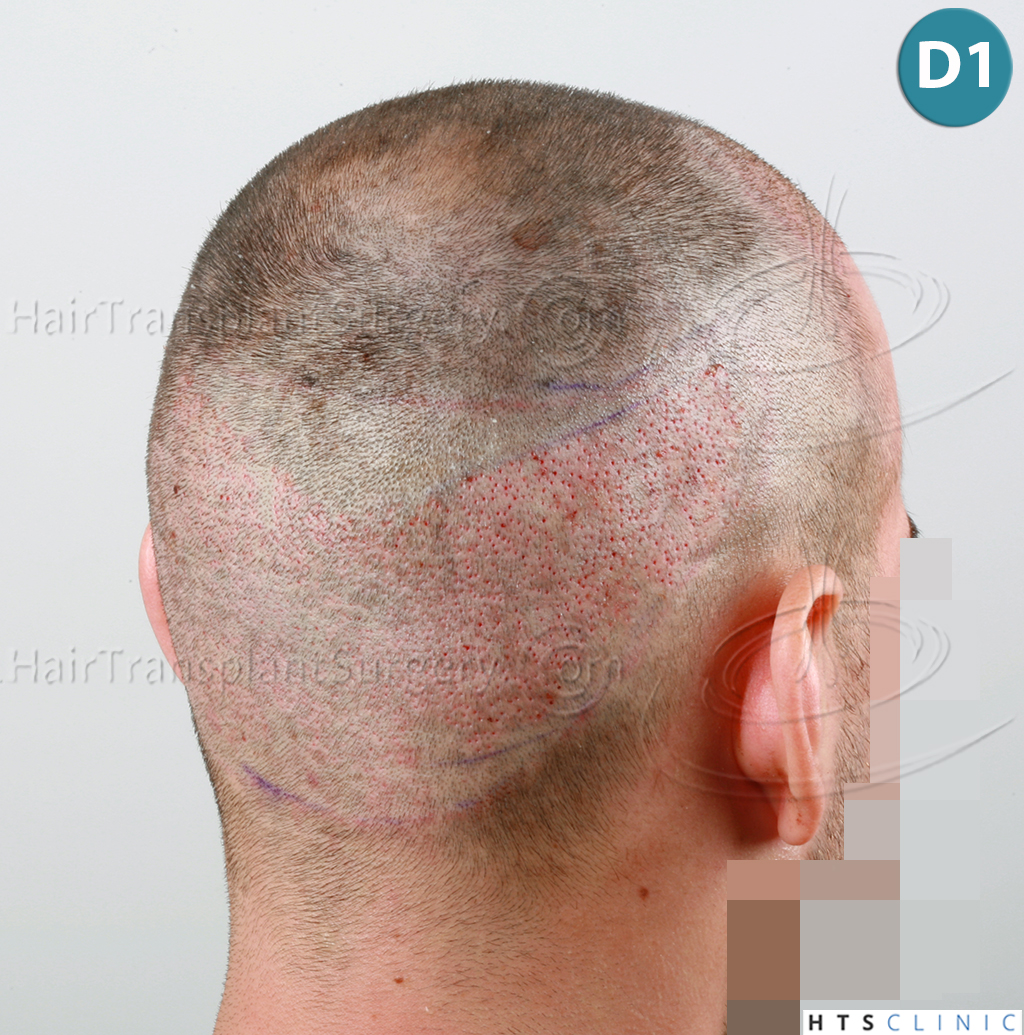 Dr.Devroye-HTS-Clinic-1880-FUE-NW-III-12.jpg