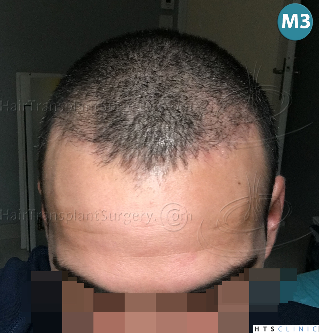 Dr.Devroye-HTS-Clinic-1880-FUE-NW-III-13.jpg
