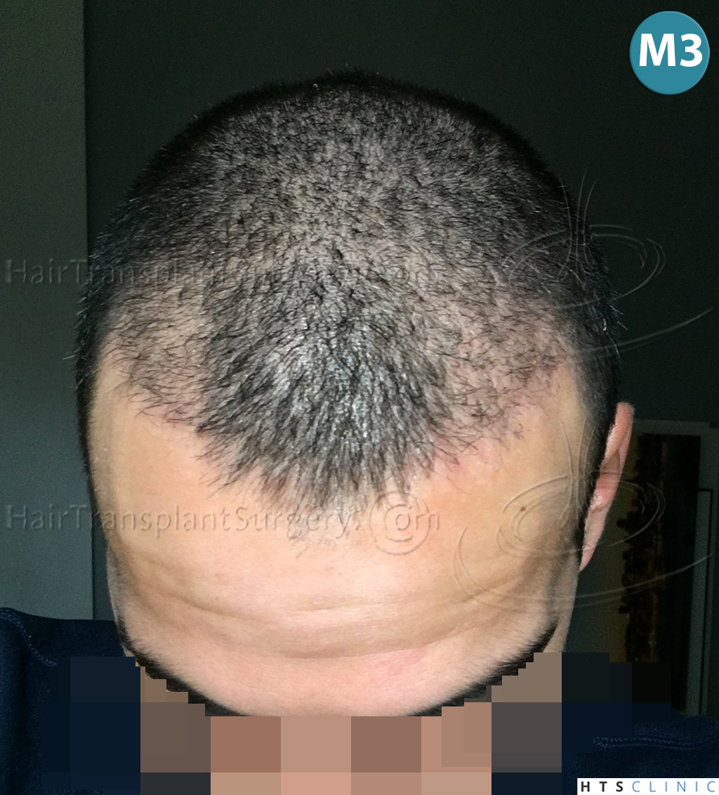 Dr.Devroye-HTS-Clinic-1880-FUE-NW-III-14.jpg