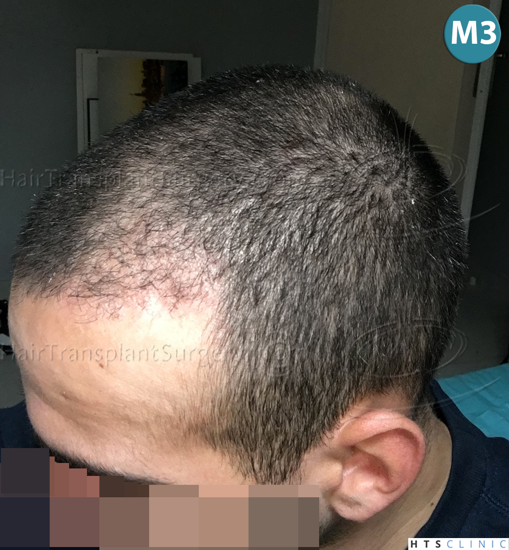 Dr.Devroye-HTS-Clinic-1880-FUE-NW-III-15.jpg