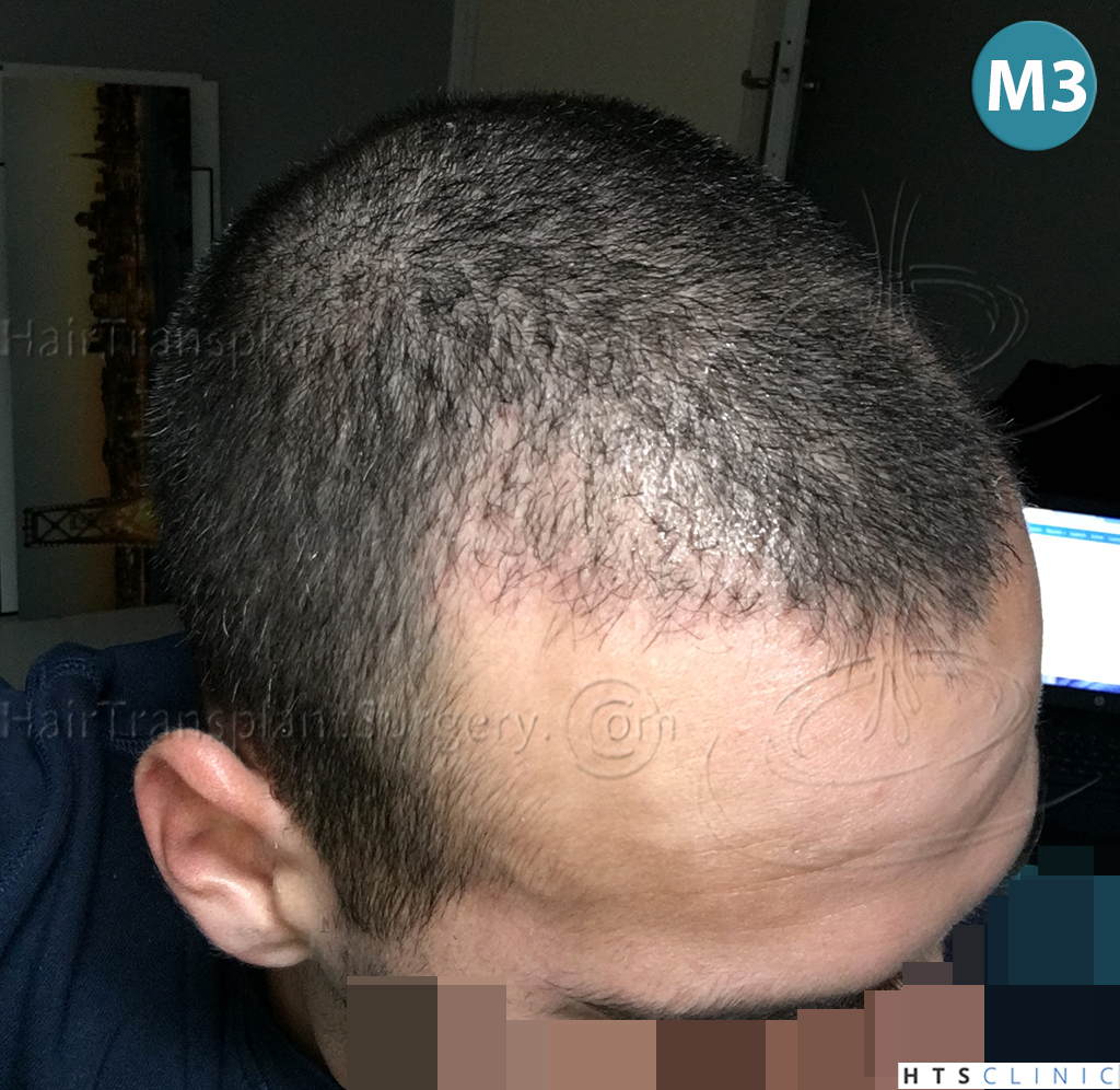 Dr.Devroye-HTS-Clinic-1880-FUE-NW-III-16.jpg
