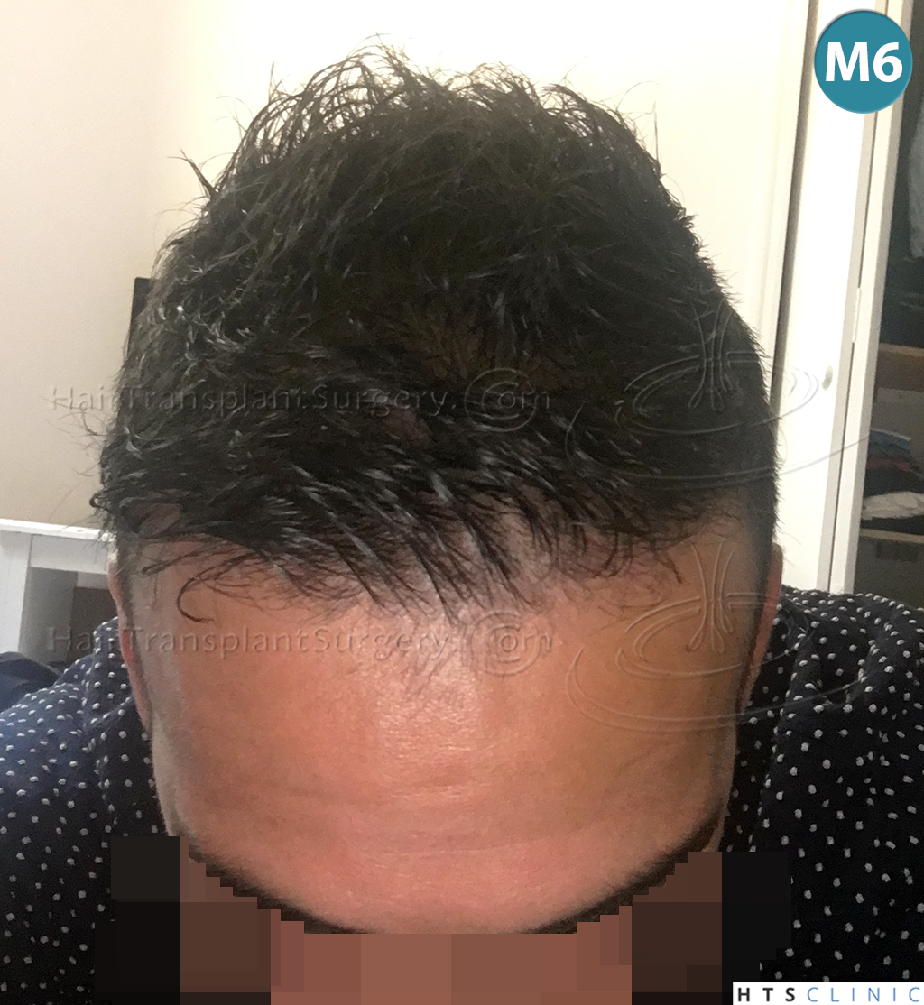 Dr.Devroye-HTS-Clinic-1880-FUE-NW-III-17.jpg
