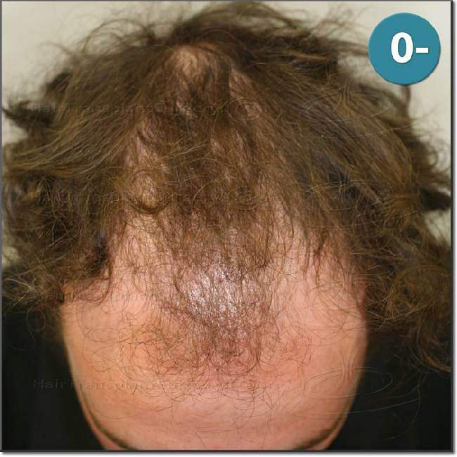 Dr.Devroye-HTS-Clinic-2987-FUT-NW-IV-2.jpg