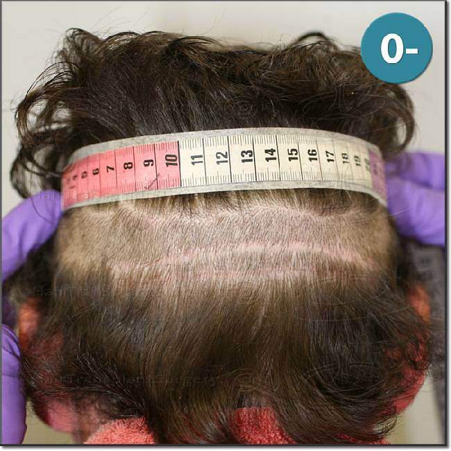 Dr.Devroye-HTS-Clinic-2987-FUT-NW-IV-6.jpg