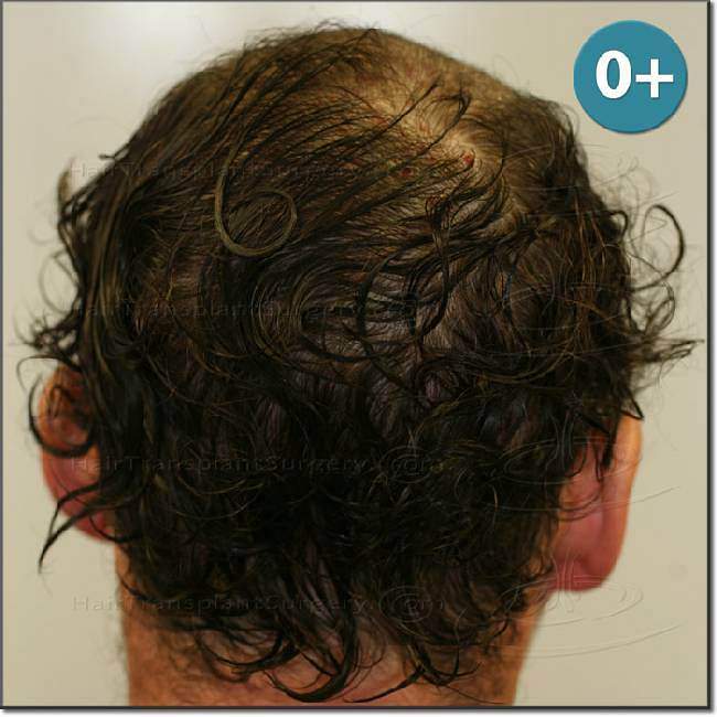 Dr.Devroye-HTS-Clinic-2987-FUT-NW-IV-10.jpg