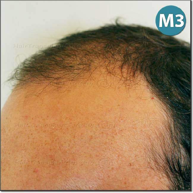 Dr.Devroye-HTS-Clinic-2987-FUT-NW-IV-13.jpg