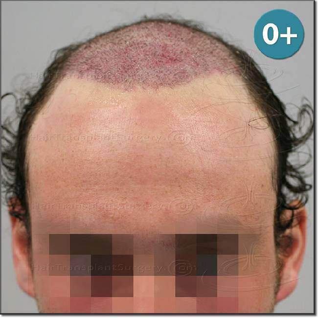 Dr.Devroye-HTS-Clinic-2987-FUT-NW-IV-7.jpg